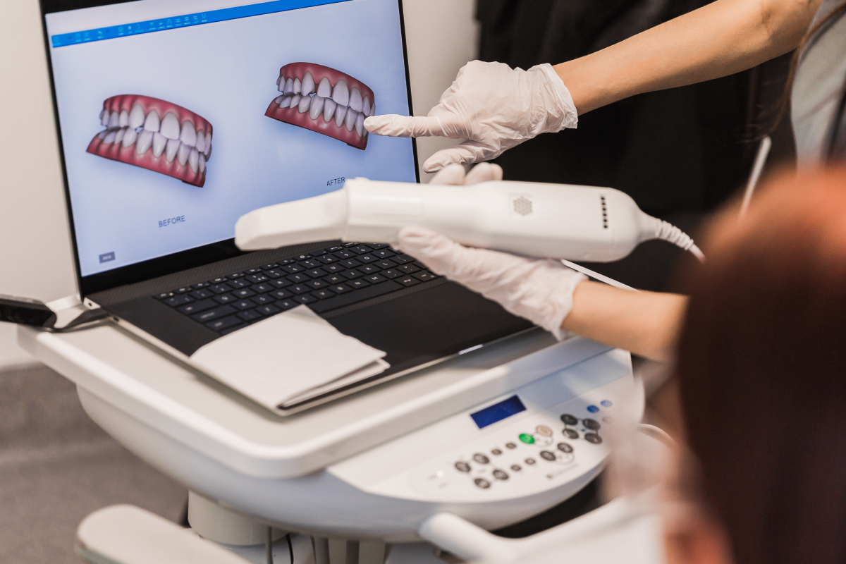 Prise d’empreinte numérique dentaire avec un scanner intra-oral