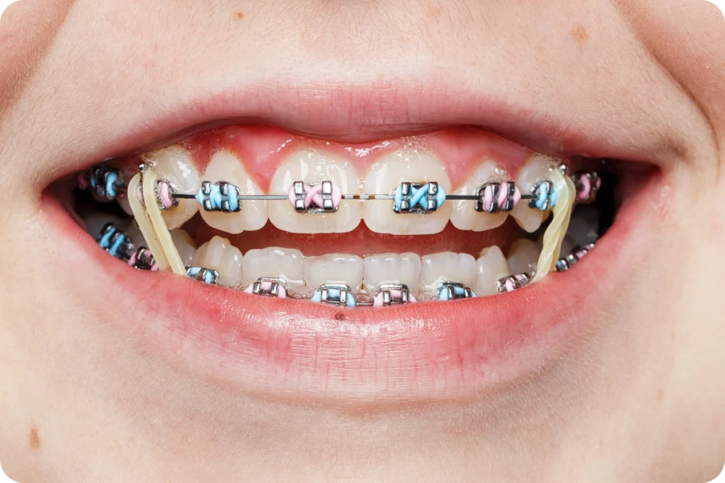 Élastiques orthodontiques posés sur un appareil multi-attaches