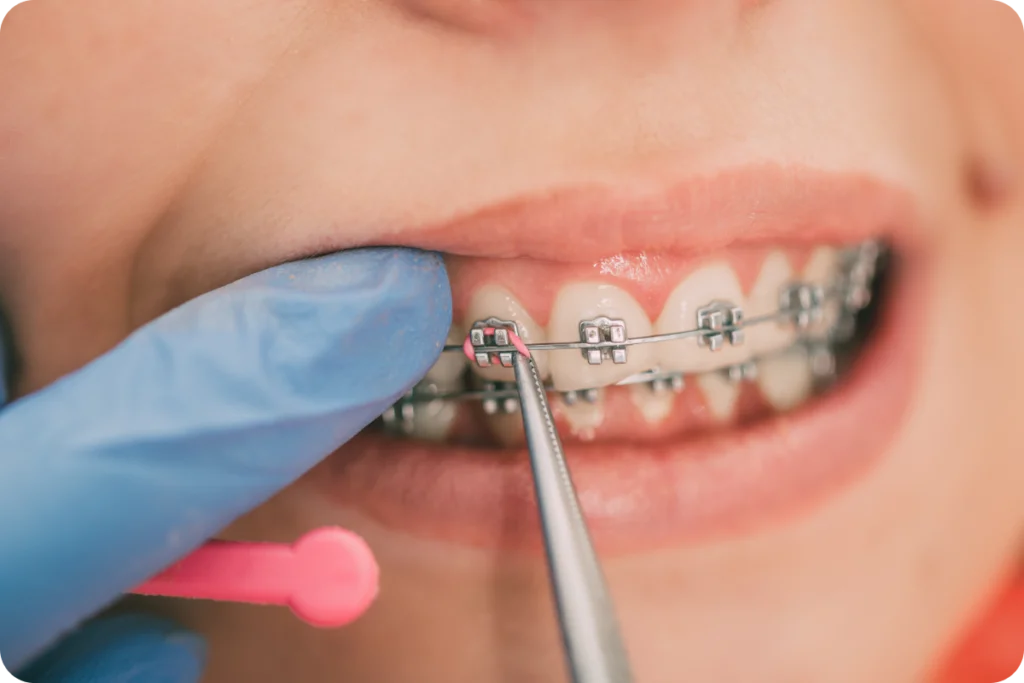 Gros plan sur un appareil multi-attaches et son arc orthodontique