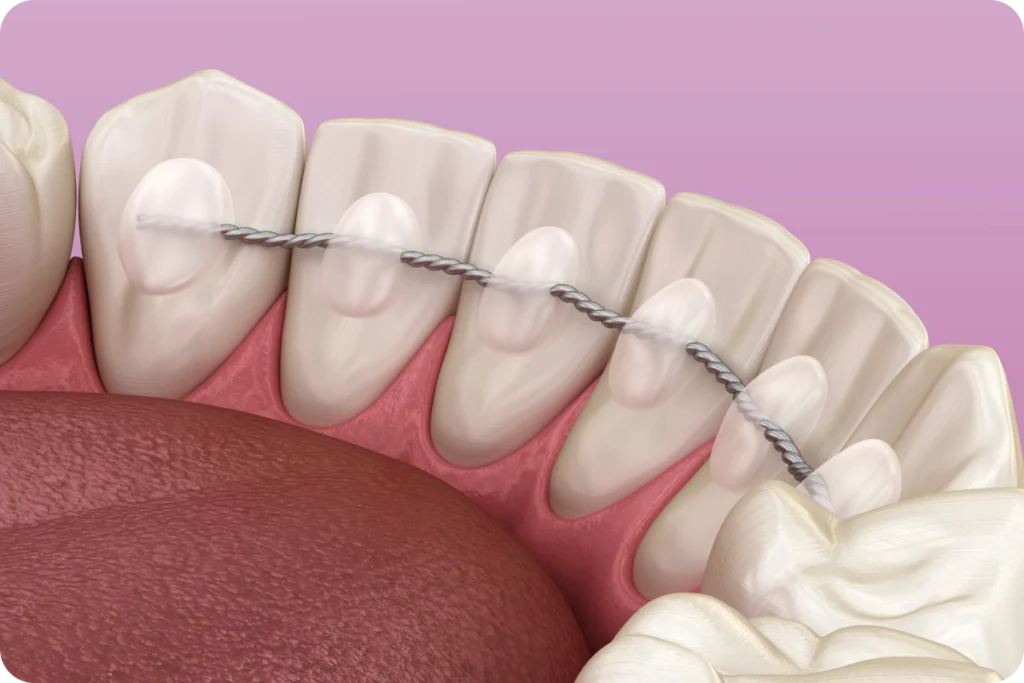 Fil de contention collé derrière les dents du bas, vue 3D