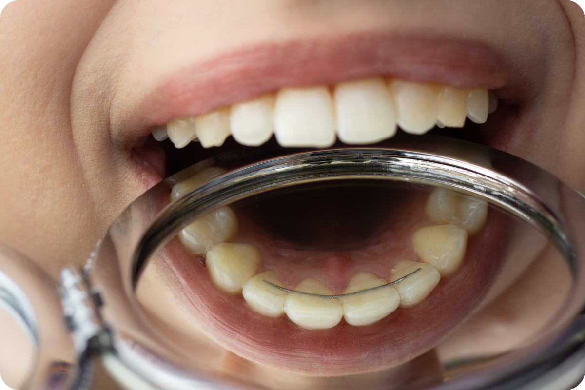 Contention orthodontique après traitement