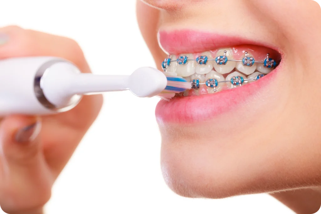 Brossage électrique des dents équipées d’un appareil multi-attaches