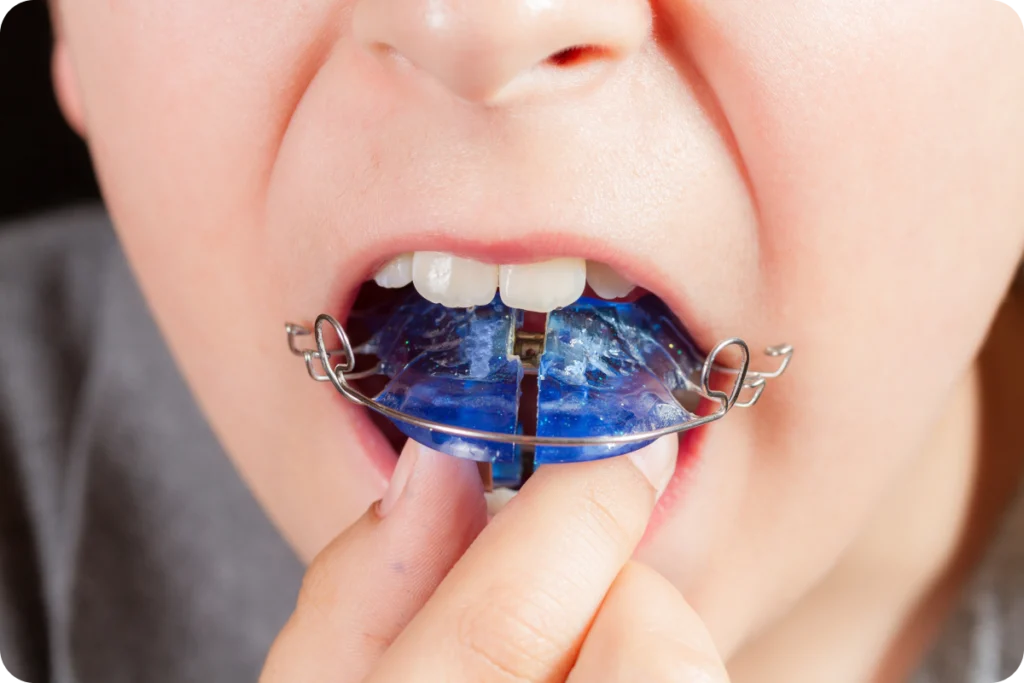 Plaque amovible bleue mise en place dans la bouche d’un enfant